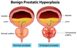 Enlarged Prostate (BPH): Symptoms, Causes, Diagnosis and Treatment Options